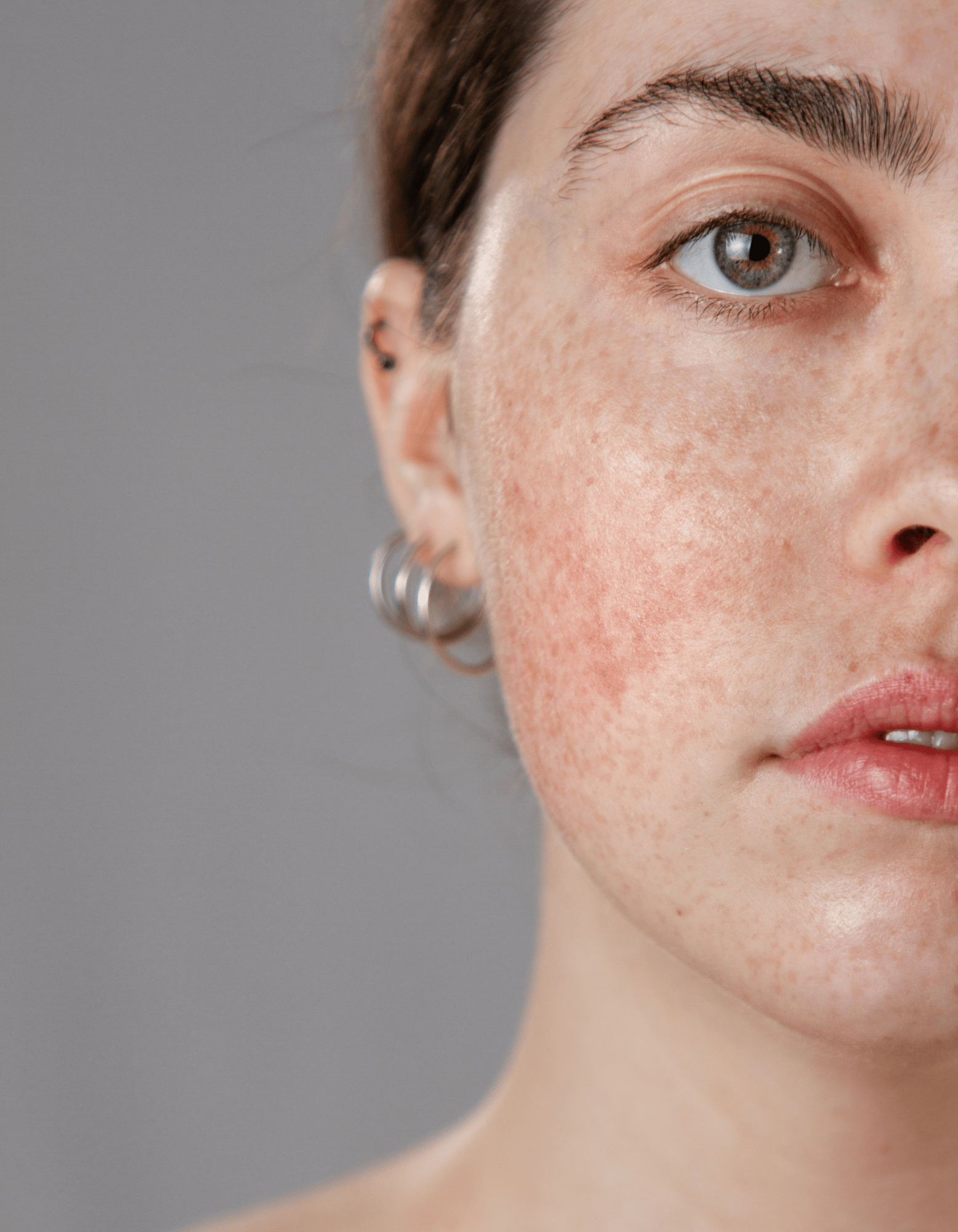 Meisje met rosacea